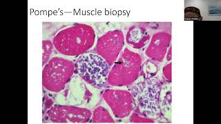 Metabolic myopathies Dr Y Anziska [upl. by Lyrrad632]