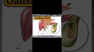 Gallstones  Cholelithiasis  Cholilithiasis  Epigastrium Pain on Ultrasound [upl. by Evalyn]