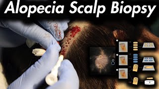 Hair Loss Consider a Scalp Biopsy [upl. by Francie]