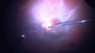 Surgery Vitrectomy for Retinal Detachment Assortment of Cases [upl. by Ahsats]