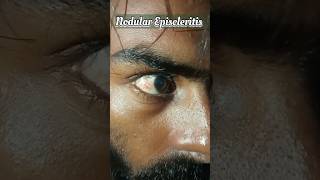 Noduler Episcleritis Live Demo Video nationalpandeyg eyecondition eyediseases [upl. by Oleg]