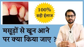 मसूड़ों से खून रोकने के घरेलू उपचार  How to Treat Bleeding gums  Dr Ankit Seraphic Dental Indore [upl. by Yanrahs]