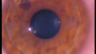 Purkinje images in keratoconus [upl. by Johnnie197]