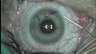 Refractive Surgery LASIK [upl. by Neved884]