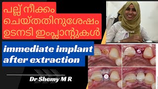 Immediate DENTAL IMPLANT after tooth extraction പല്ലെടുത്ത ഉടനെ DENTAL IMPLANT ചെയ്യാമോ Dr SHEMY [upl. by Barbaraanne589]