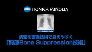 病変を画像技術で見えやすく「胸部Bone Suppression処理」  コニカミノルタ [upl. by Rhetta944]