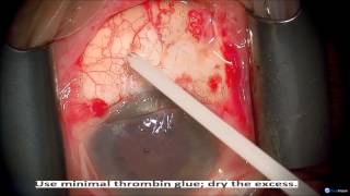 Primary Pterygium Surgery with AmnioGraft Neel Desai MD [upl. by Harwin]