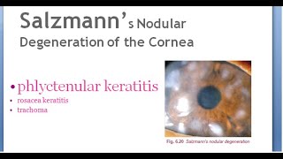 Ophthalmology Salzmann nodular degeneration of cornea phlyctenular rosacea keratitis trachoma [upl. by Ahsinor]