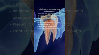 Endodoncia ¿cuándo es necesario realizarla [upl. by Locke]