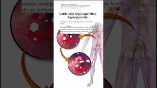 Detriments of perioperative hyperglycemia [upl. by Lehpar]