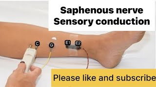 SAPHENOUS NERVE sensory nerve NCS neurology neurotech [upl. by Lyons519]