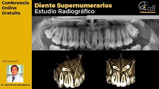 Dientes Supernumerarios Estudio Radiográfico [upl. by Eiddam]