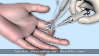 CapFlex PIP – Endoprosthetic treatment of the proximal interphalangeal joint palmar approach [upl. by Ydnih]