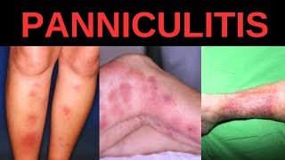 WHAT IS PANNICULITIS SYMPTOMS CAUSES TREATMENT [upl. by Eibrab903]