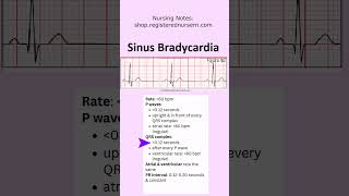 Sinus Bradycardia ECG EKG Nursing Treatment Rhythm Made Easy in Less Than 1 Minutes nursing ecg [upl. by Hallee]