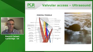 How should I make PFO closure a safe and effective procedure [upl. by Ainelec]