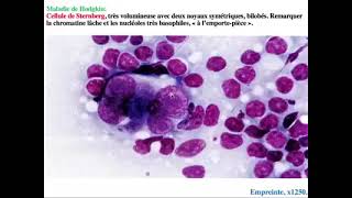 Hemato 16Lymphome Hodgkinien et non Hodgkinien Dr Abbadi [upl. by Notneb]