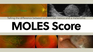 Telling the difference between a choroidal naevus and a melanoma The MOLES Score  OT Skills Guide [upl. by Palmer821]