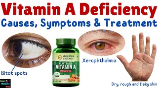 Vitamin A Deficiency – Causes Symptoms Diagnosis Treatment amp Prevention [upl. by Niatsirk]