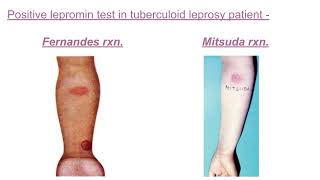 Lepromin test pathology mbbs [upl. by Hodess835]