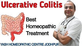 Ulcerative Colitis treatment ।IBS ।stomach pain।blood mucus in stool homeopathy Treatment [upl. by Anaihr902]