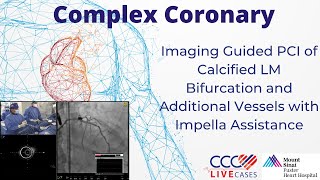 Imaging Guided PCI of Calcified LM Bifurcation and Additional Vessels with Impella Assistance [upl. by Mouldon]