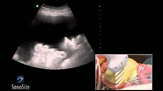 How To Ultrasound Guided Paracentesis Procedure 3D Video [upl. by Elohcim]