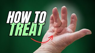 Dupuytrens Contracture Starts as Lump on Hand How to Treat [upl. by Dranreb659]