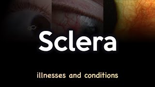 Sclera Illnesses and Conditions [upl. by Annoyt]