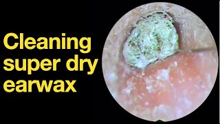 Cleaning super dry earwax ear wax removal  ear cleaning  ASMR  relaxation  relax [upl. by Nalrah]