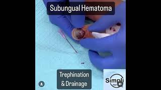 Subungual Hematoma Trephination [upl. by Hinson]