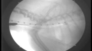 Primary Tracheal Collapse6DAY29Stent Placement under fluoroscopy [upl. by Malcah448]