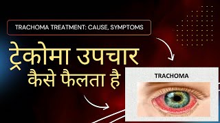 quotTrachoma Treatment Cause Symptoms  IN HINDI ट्रेकोमा उपचारकैसे फैलता है” [upl. by Benedict]