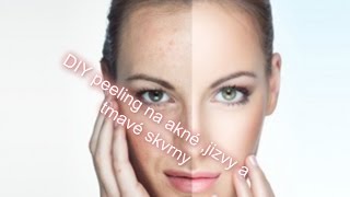 DIY peeling na akné jizvy a tmavé skvrny [upl. by Sapphira26]