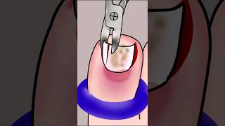 ASMR Ingrown Toenail Removal Treatment P3 asmr animation satisfying viral trending shorts [upl. by Caddaric]