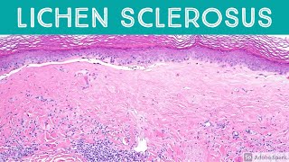 Lichen Sclerosus et atrophicus Inflammatory Dermpath Basics for Dermatology amp Pathology [upl. by Leitnahs]