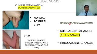 Congenital Talipes Equino Varus CTEV  Rapid Revision of Orthopaedics by Dr Prateek Joshi [upl. by Dranoel]