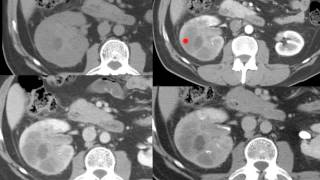 AULA Radiologia de nódulos renais e adrenais  Renal and adrenal nodules imaging [upl. by Bravar6]