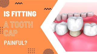 Is fitting a tooth cap a painful process [upl. by Aldo]