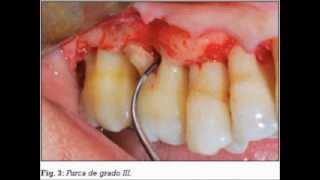 Indicaciones cirugia periodontal 3007 tema 2wmv [upl. by Sile]