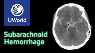 Subarachnoid Hemorrhage amp Treatment  nimodipine USMLE STEP 1 UWORLD Questions Nervous system [upl. by Ilrebmik531]