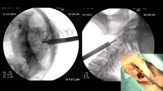 Odontoid Screw Fixation by Rick C Sasso MD [upl. by Georg]