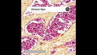 Chronic Myeloid Leukemia EN [upl. by Hibbs]