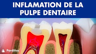 Pulpite – Inflamation de la pulpe dentaire © [upl. by Weisberg661]