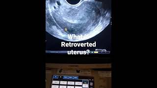 what is Retroverted uterusand how looks on tvs ultrasound [upl. by Ulane]