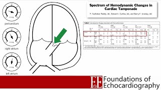 Large pericardial effusion echo findings  Cardiac tamponade   Pericardiocentesis [upl. by Ebneter]