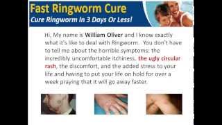 How To Get Rid of Ringworm Fast  How to Cure Ringworm Fast [upl. by Agnimod]