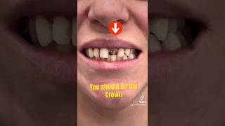 Horizontal Tooth Fracture do the Crown [upl. by Chrissy524]