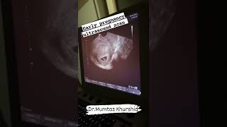 First Trimester Ultrasound Scan [upl. by Ynohtnaed]