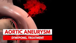 What is an Aortic Aneurysm  3D Animation [upl. by Aneed]